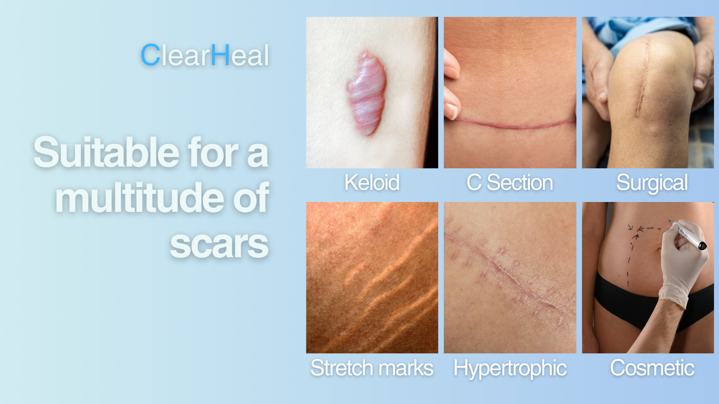 Silicone Scar Sheets - Silicone Tape for C Section Recovery and Post-Operative Surgery Stretch Marks Removal