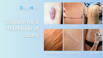 Silicone Scar Sheets - Silicone Tape for C Section Recovery and Post-Operative Surgery Stretch Marks Removal